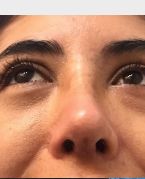 Rhinoplasty