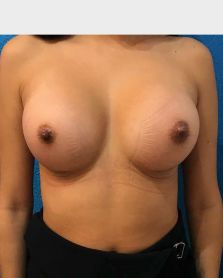 Breast Augmentation