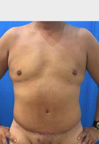 Tummy Tuck