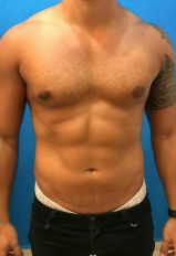 Liposuction