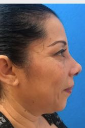 Rhinoplasty