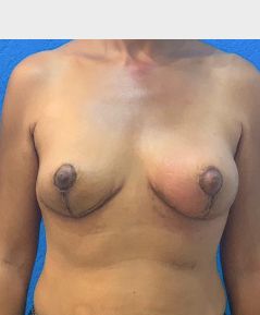 Breast Lift