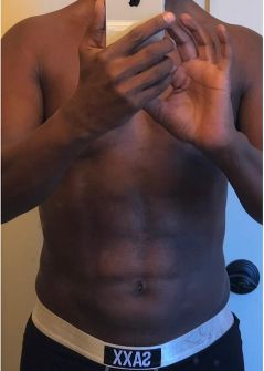 Liposuction