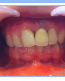 Single Dental Implant