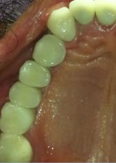 Multiple Dental Implants