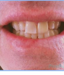 Oral Cosmetic Rehabilitation