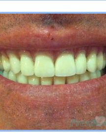 Overdenture 