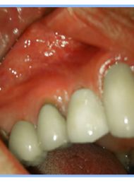 Single Dental Implant