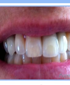 Multiple Dental Implants