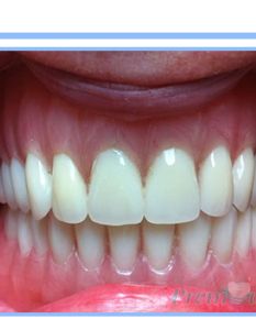 Overdenture 