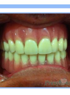 Overdenture 