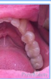 Multiple Dental Implants