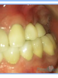 Multiple Dental Implants