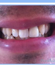 Single Dental Implant