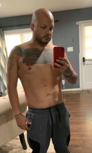 Weight-Loss Surgery