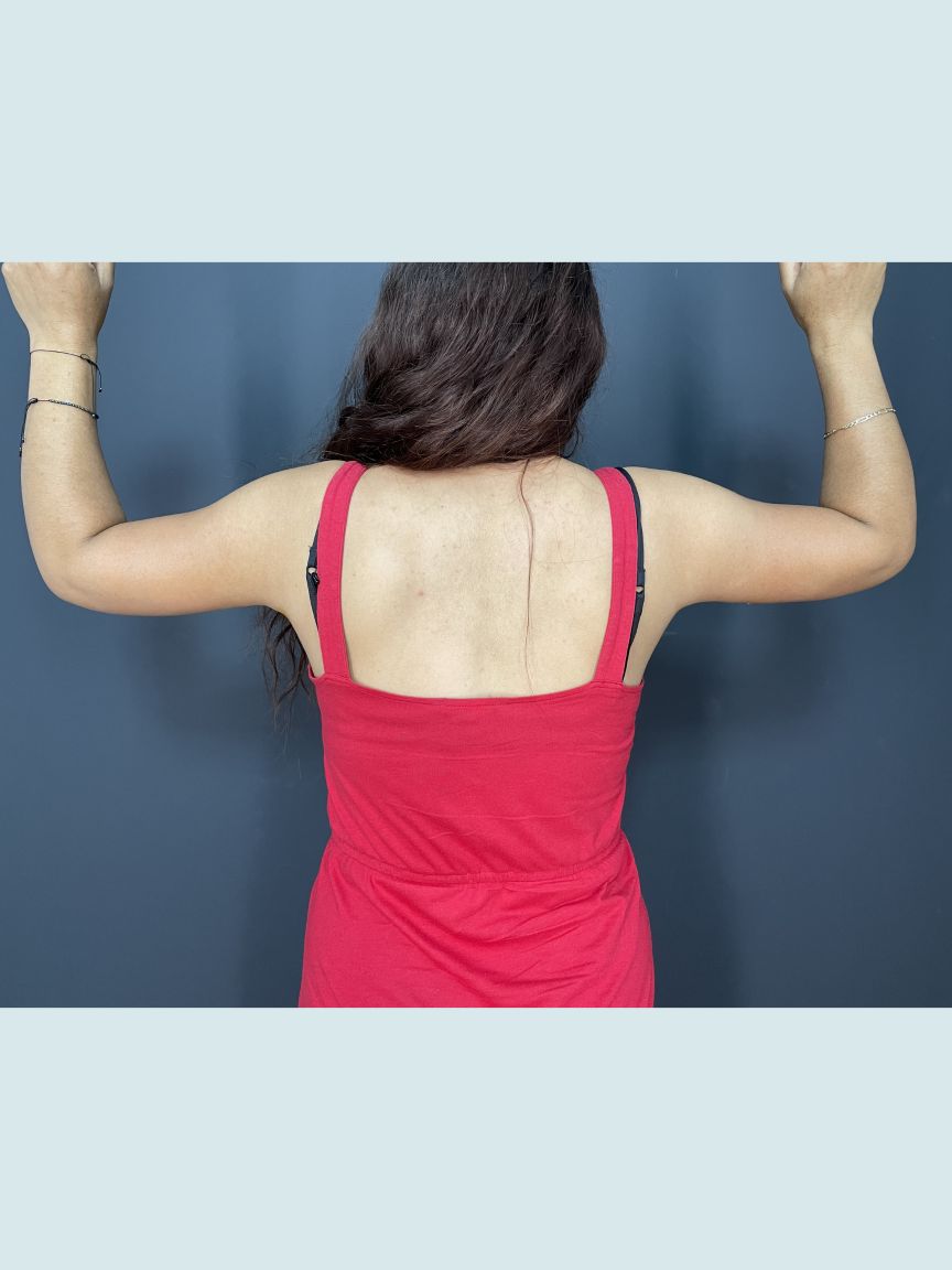 Arm Lift