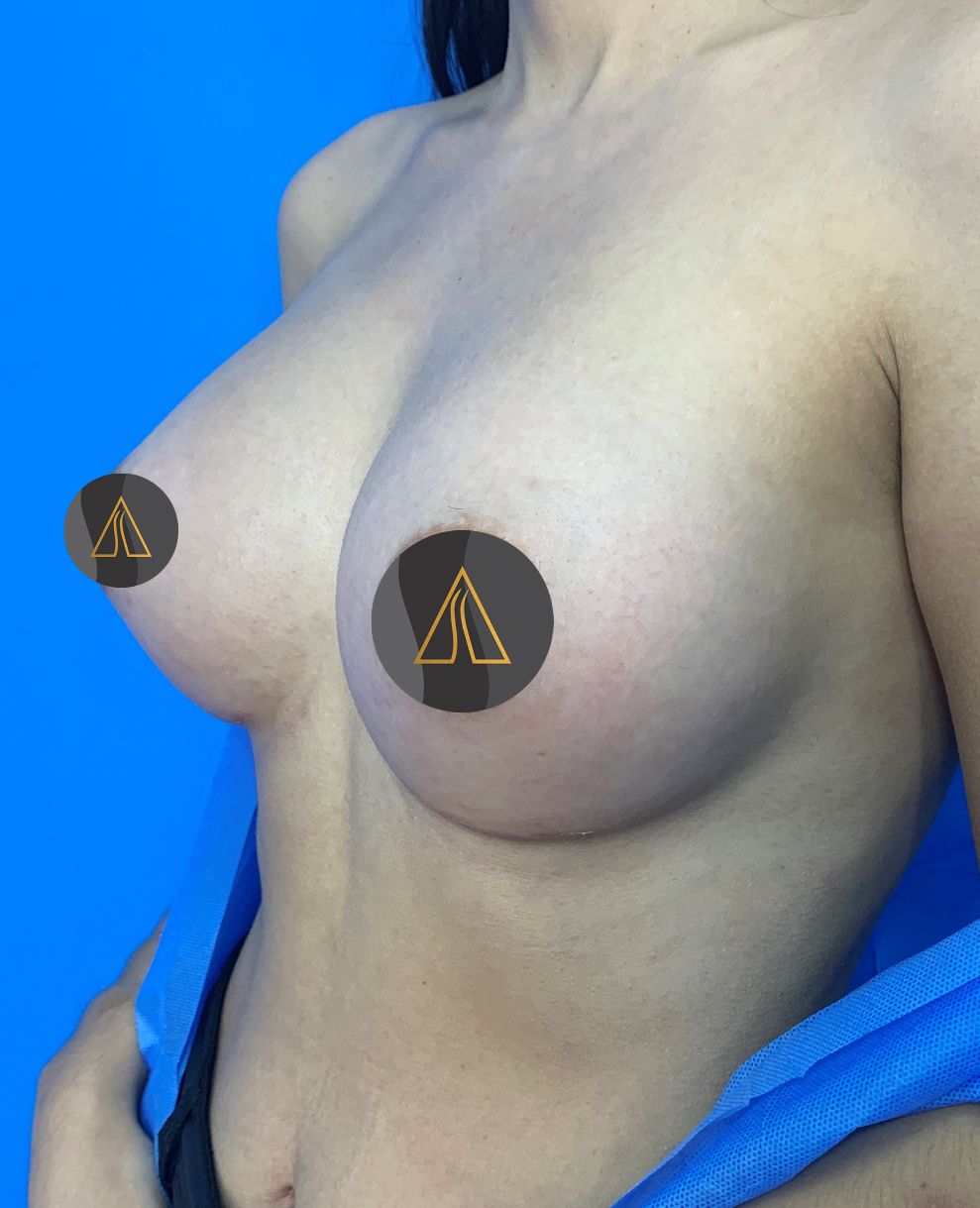 Breast Augmentation