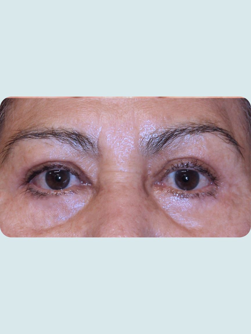 Blepharoplasty