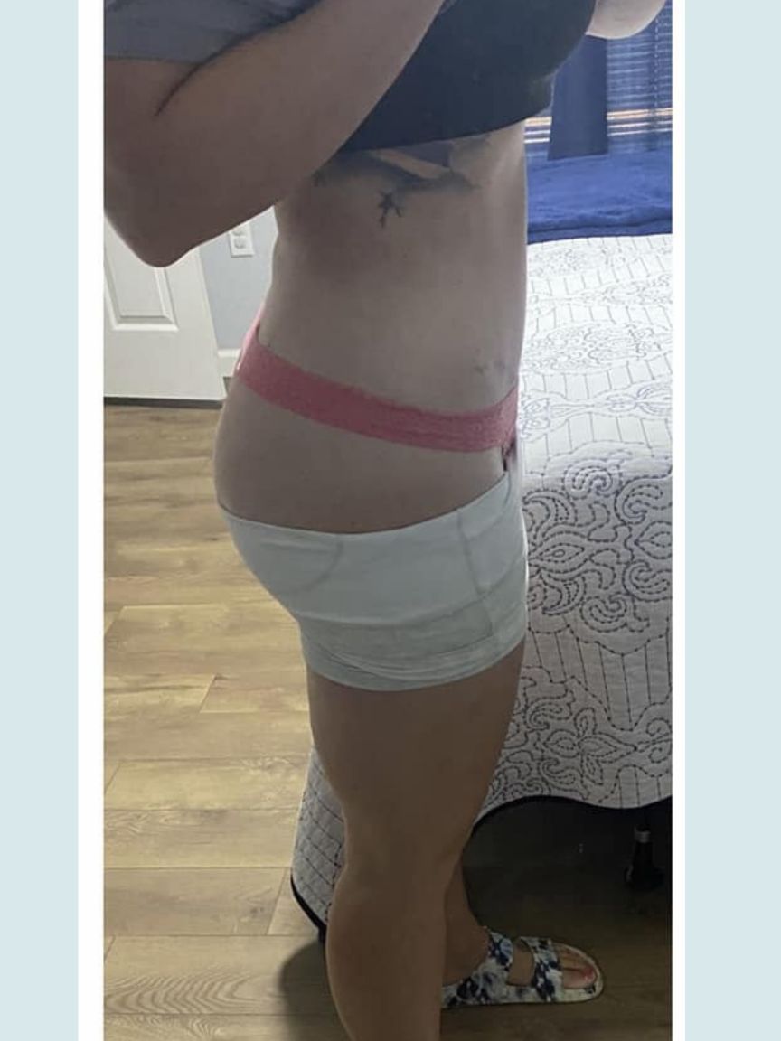 Mommy Makeover