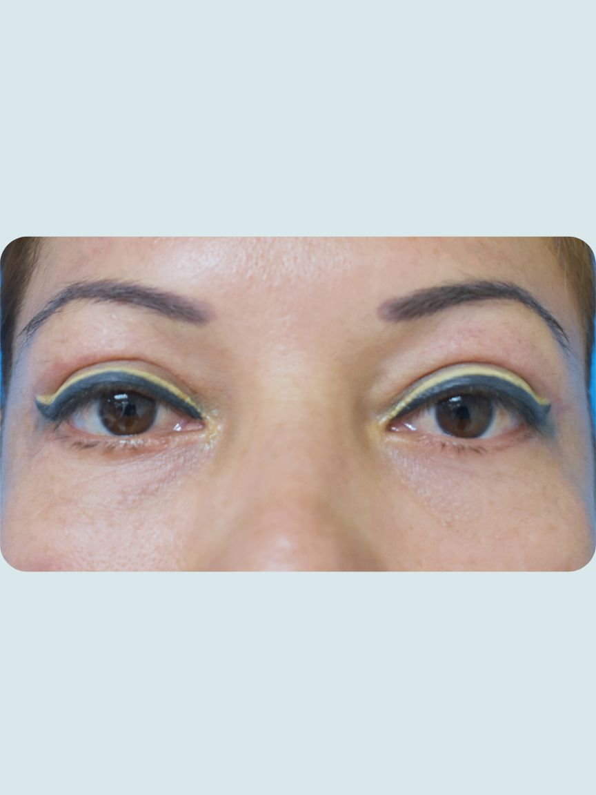 Blepharoplasty