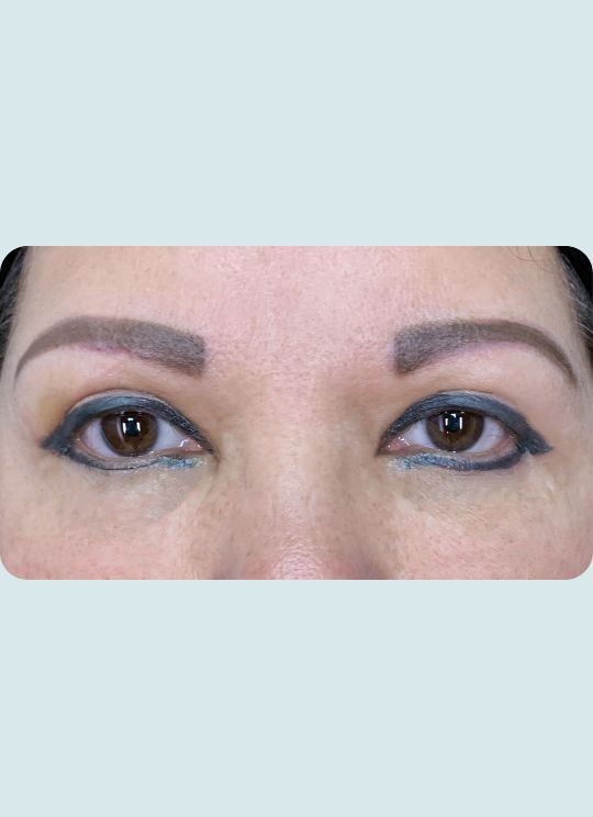 Blepharoplasty