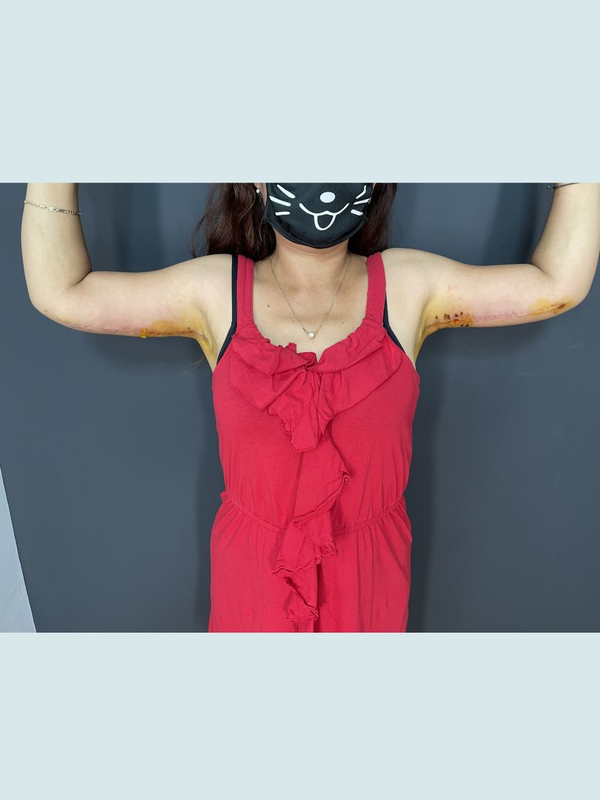 Arm Lift