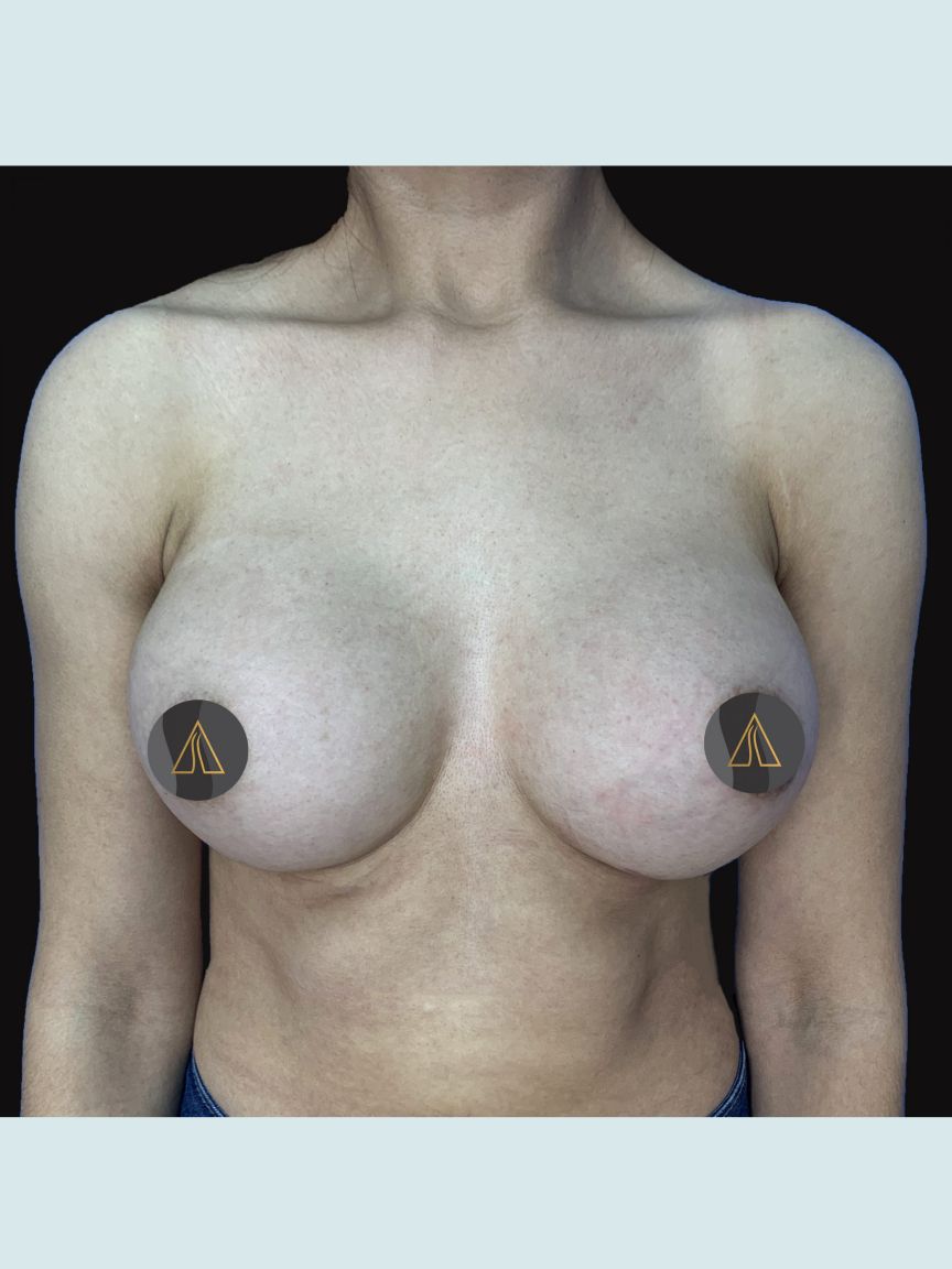 Breast Augmentation