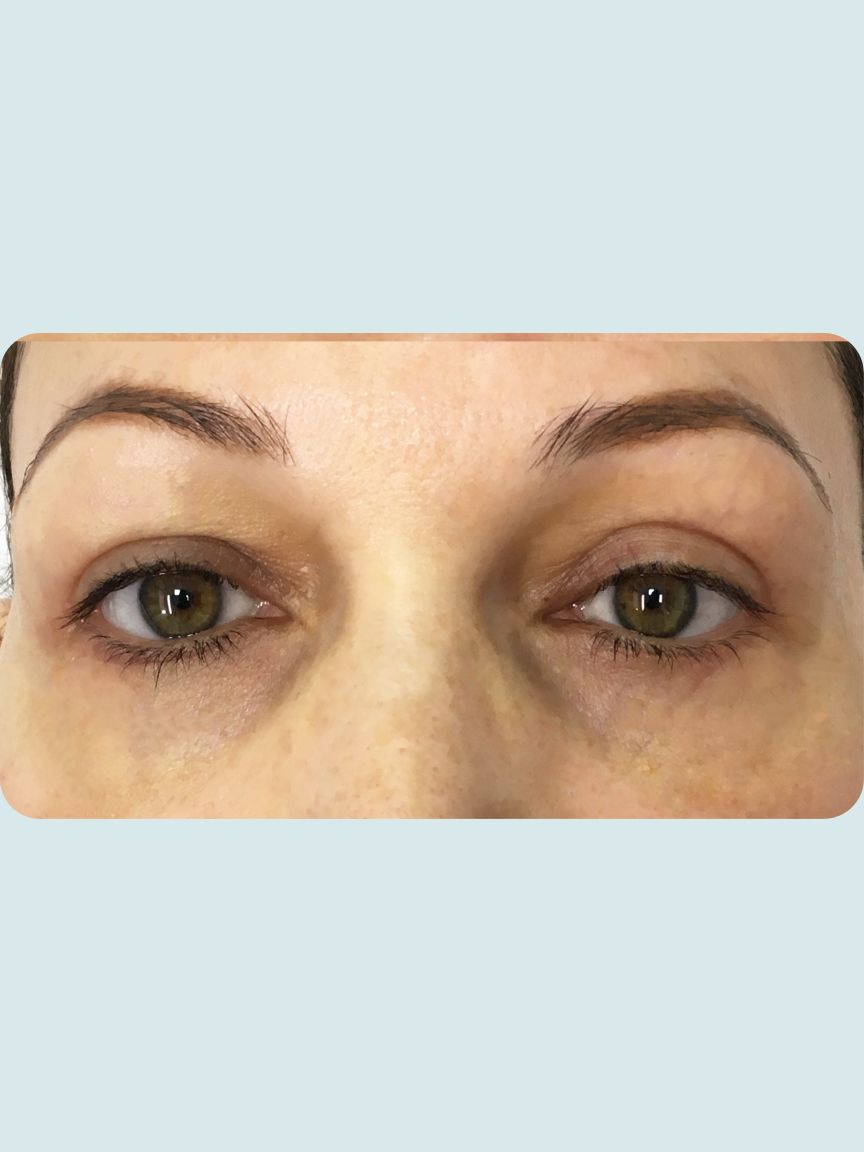Blepharoplasty
