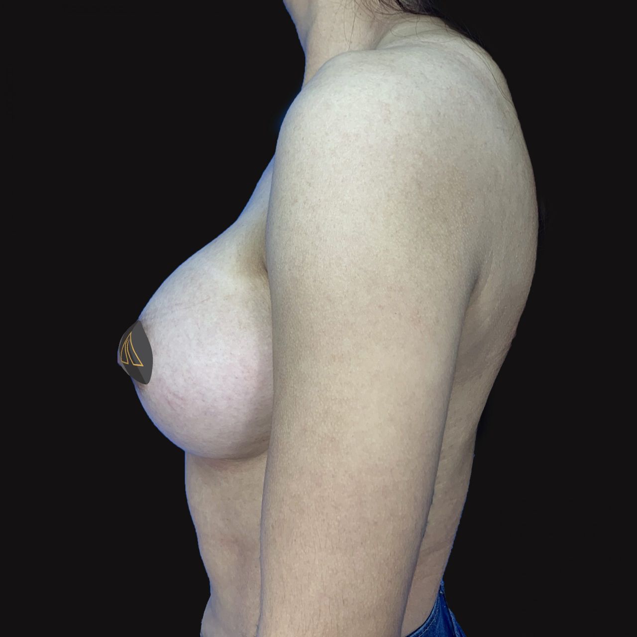 Breast Augmentation