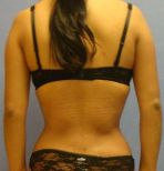 Liposuction