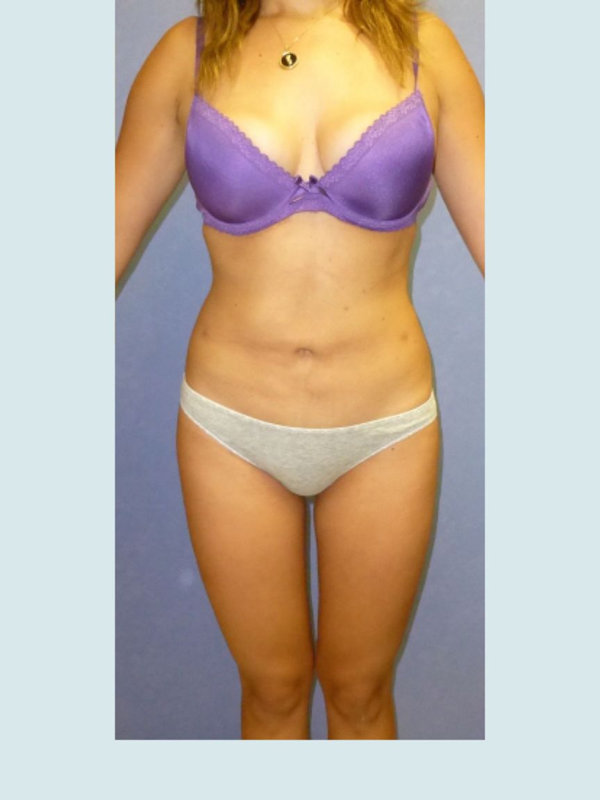 Liposuction
