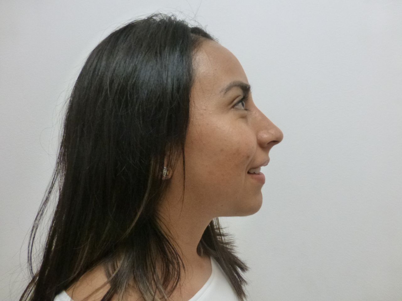 Rhinoplasty