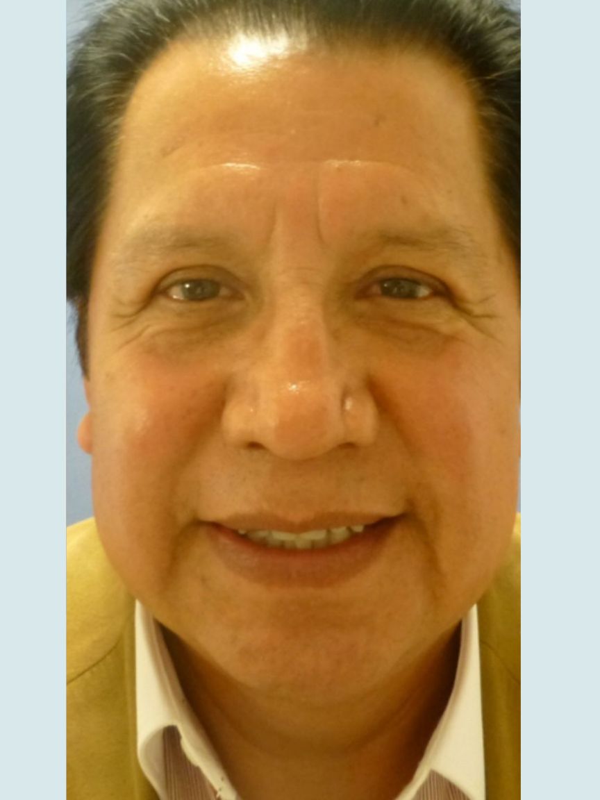 Facelift with Blepharoplasty
