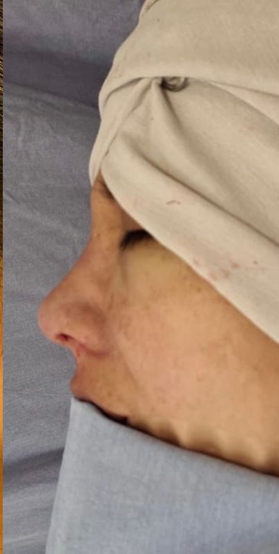 Rhinoplasty