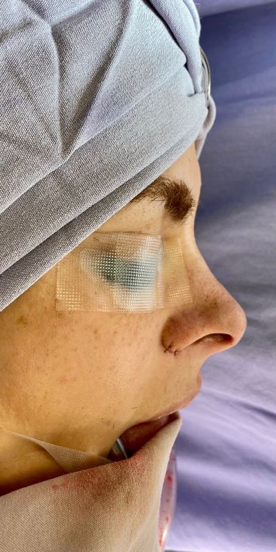 Rhinoplasty