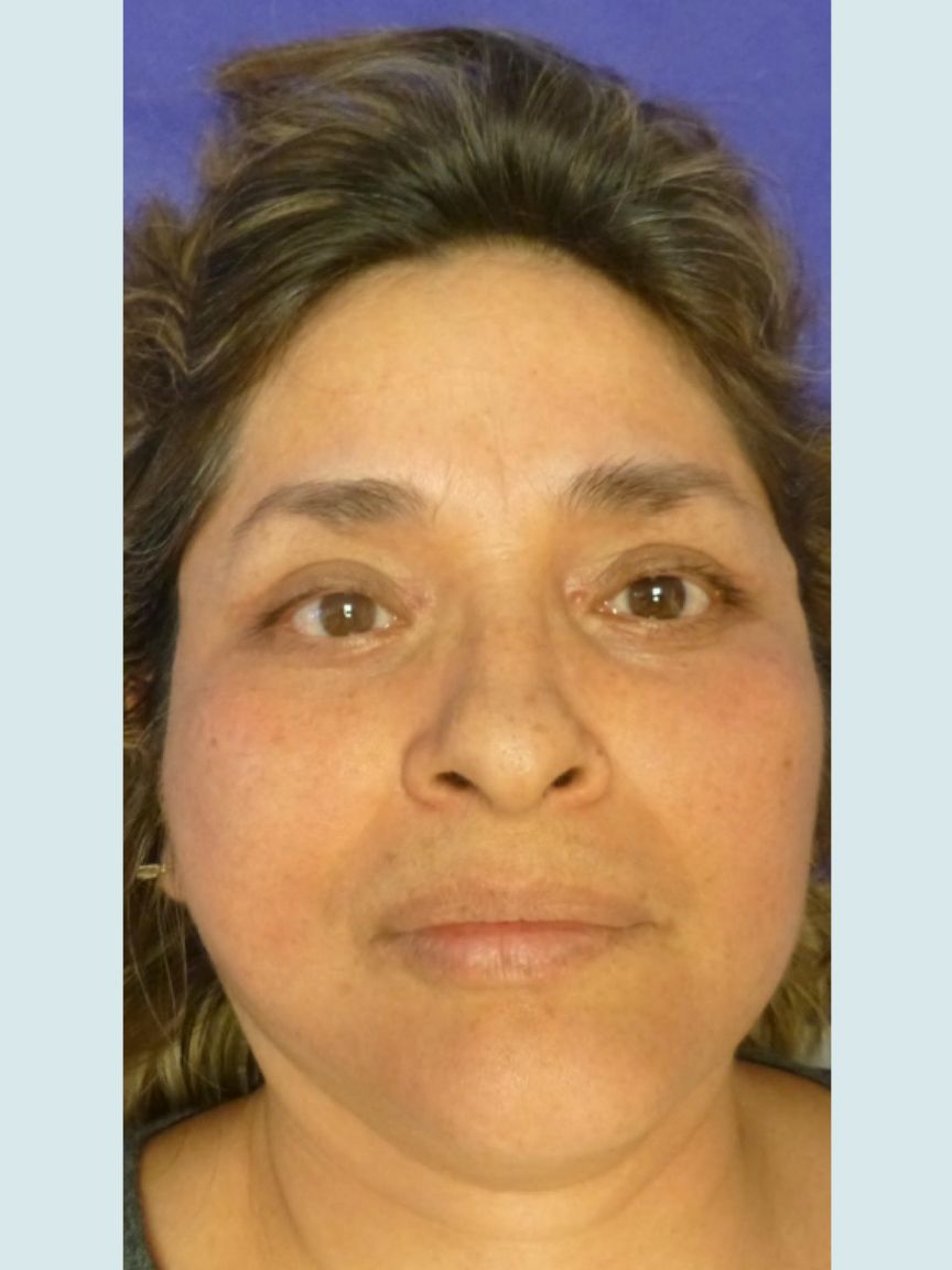 Facelift with Blepharoplasty