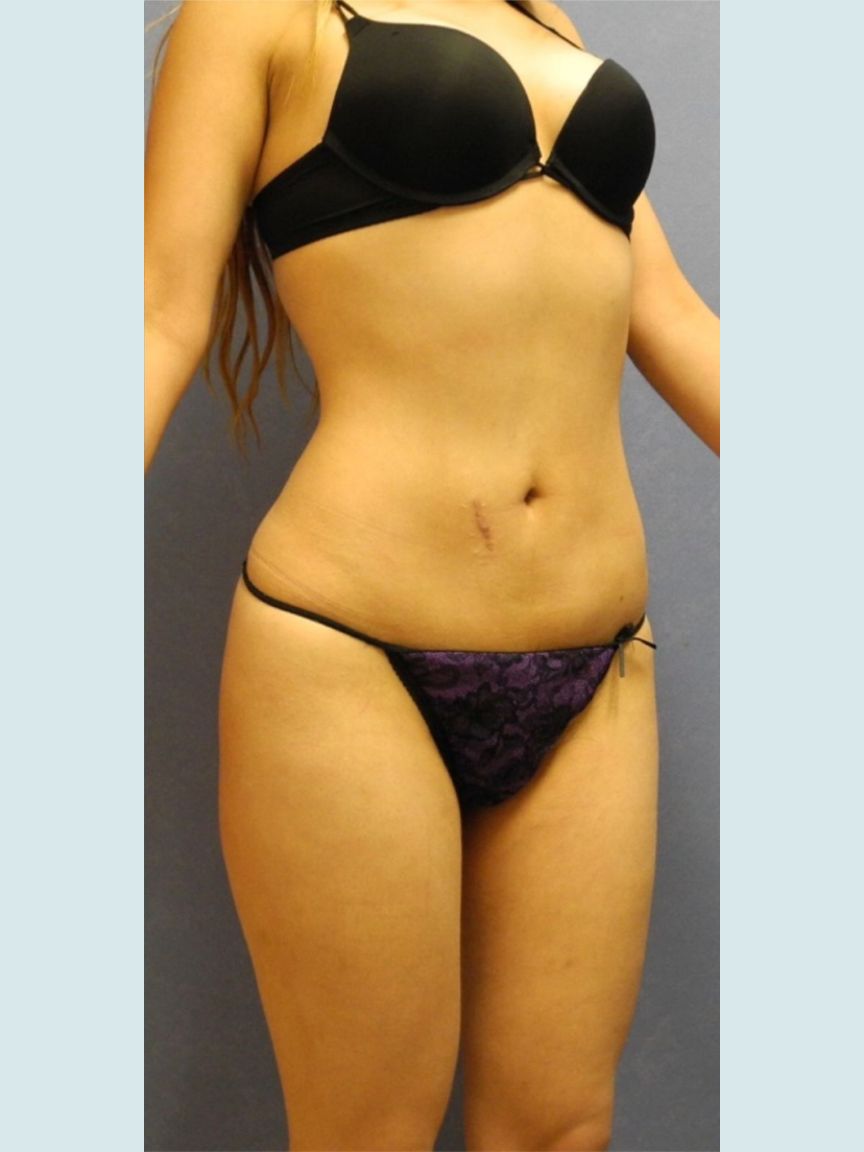 Liposuction w/ BBL