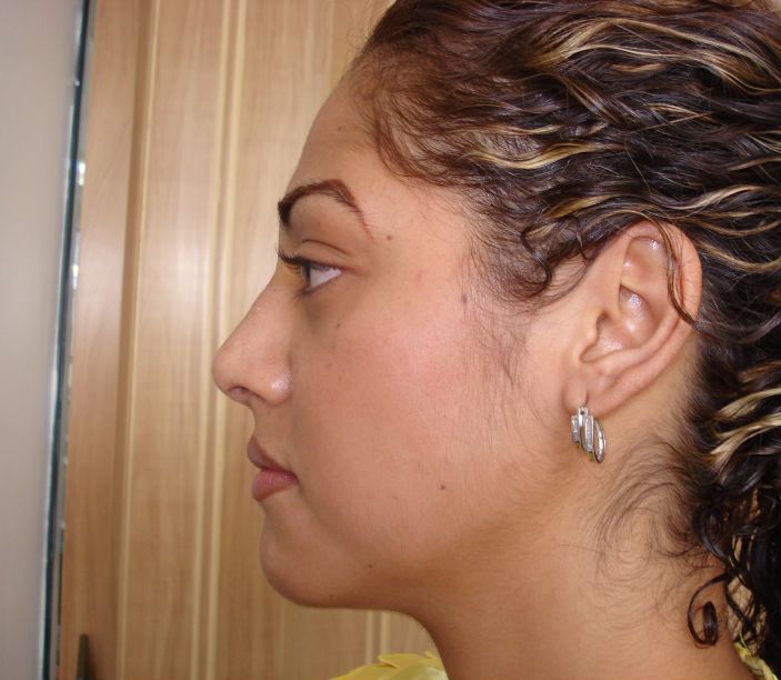 Rhinoplasty
