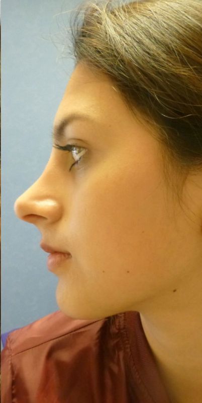 Rhinoplasty