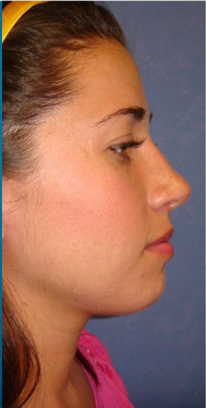 Rhinoplasty