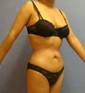 Liposuction