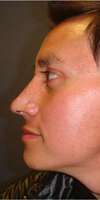 Rhinoplasty
