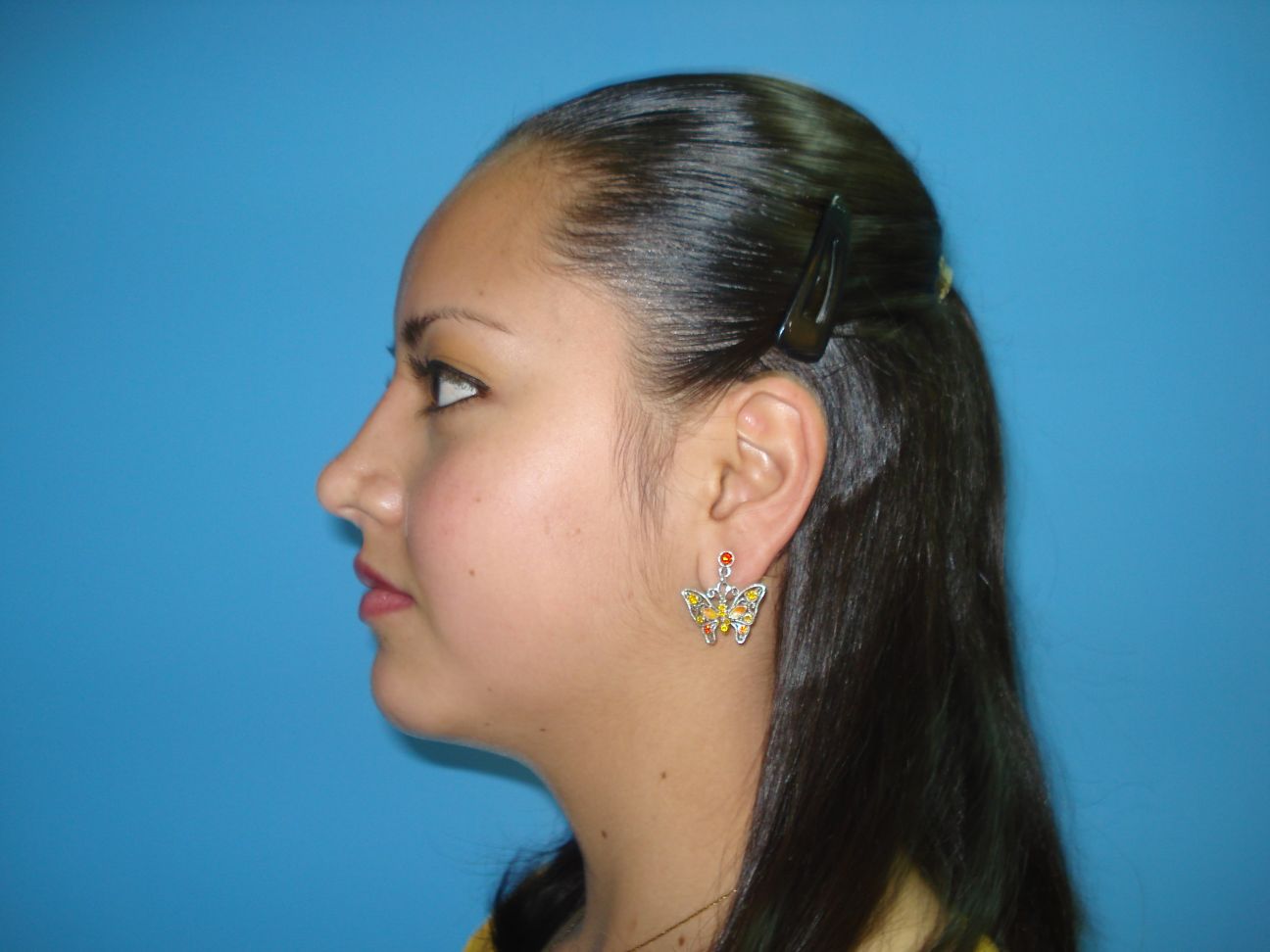 Rhinoplasty