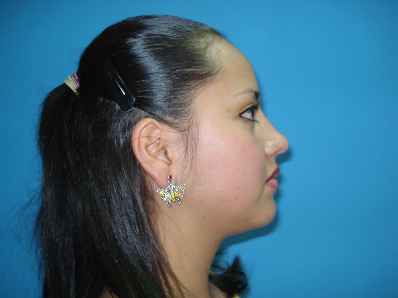 Rhinoplasty