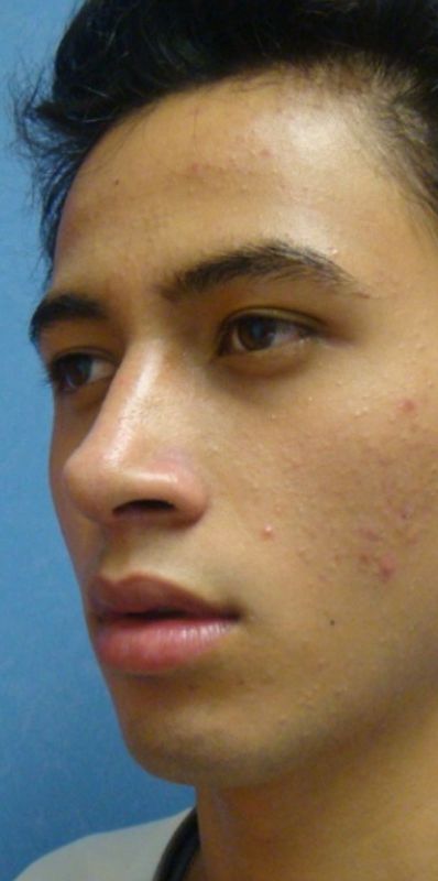 Rhinoplasty