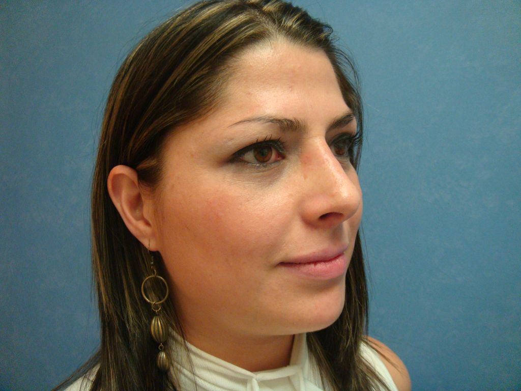 Rhinoplasty