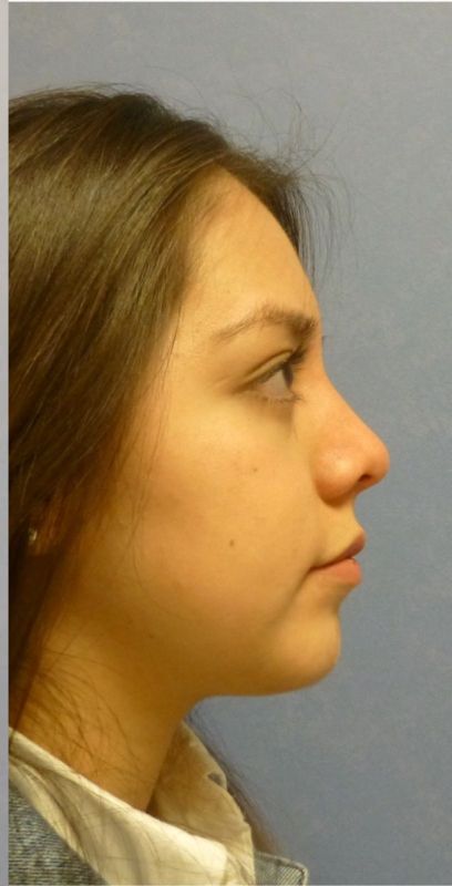 Rhinoplasty