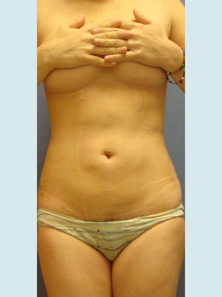 Liposuction