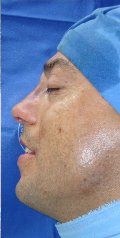 Rhinoplasty