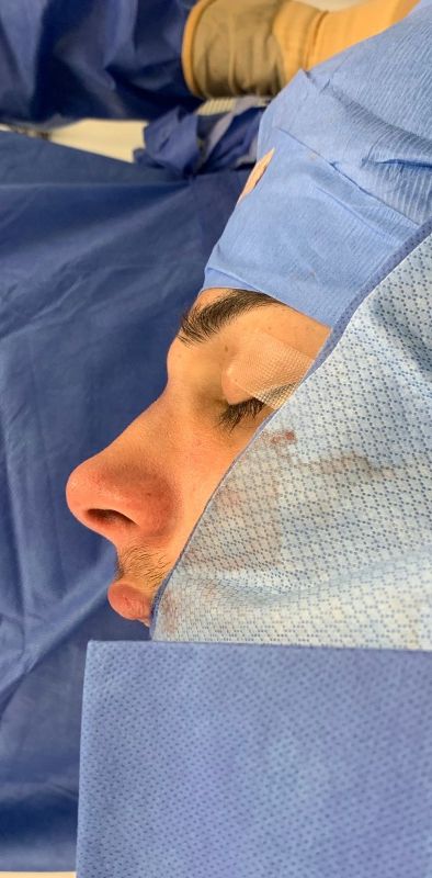 Rhinoplasty